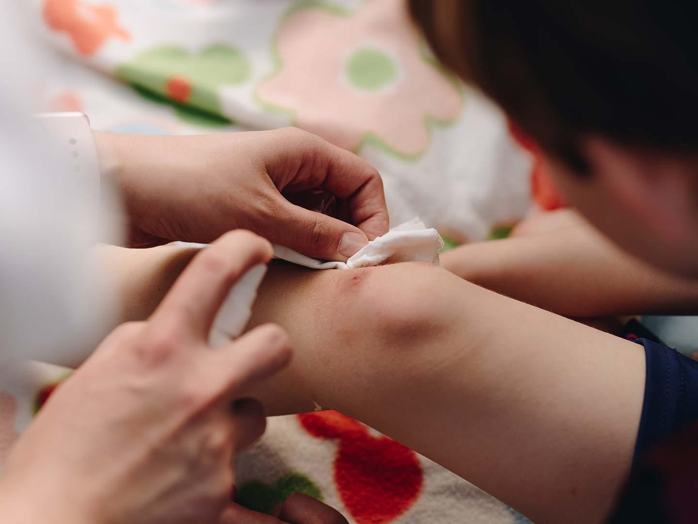 Antiseptična oskrba ran: Kdaj so dovolj antiseptiki in kdaj potrebujemo antibiotike